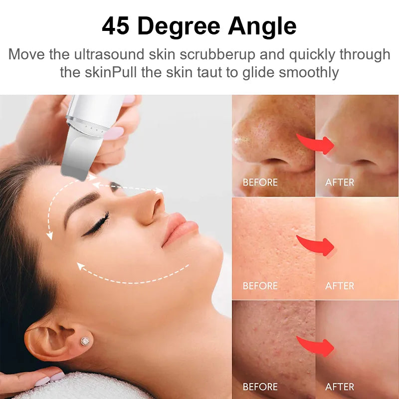 MediDerm - Ultrasonic Facial Enhancer